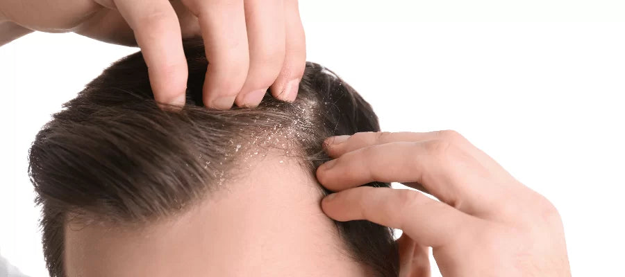 How to get rid of dandruff?